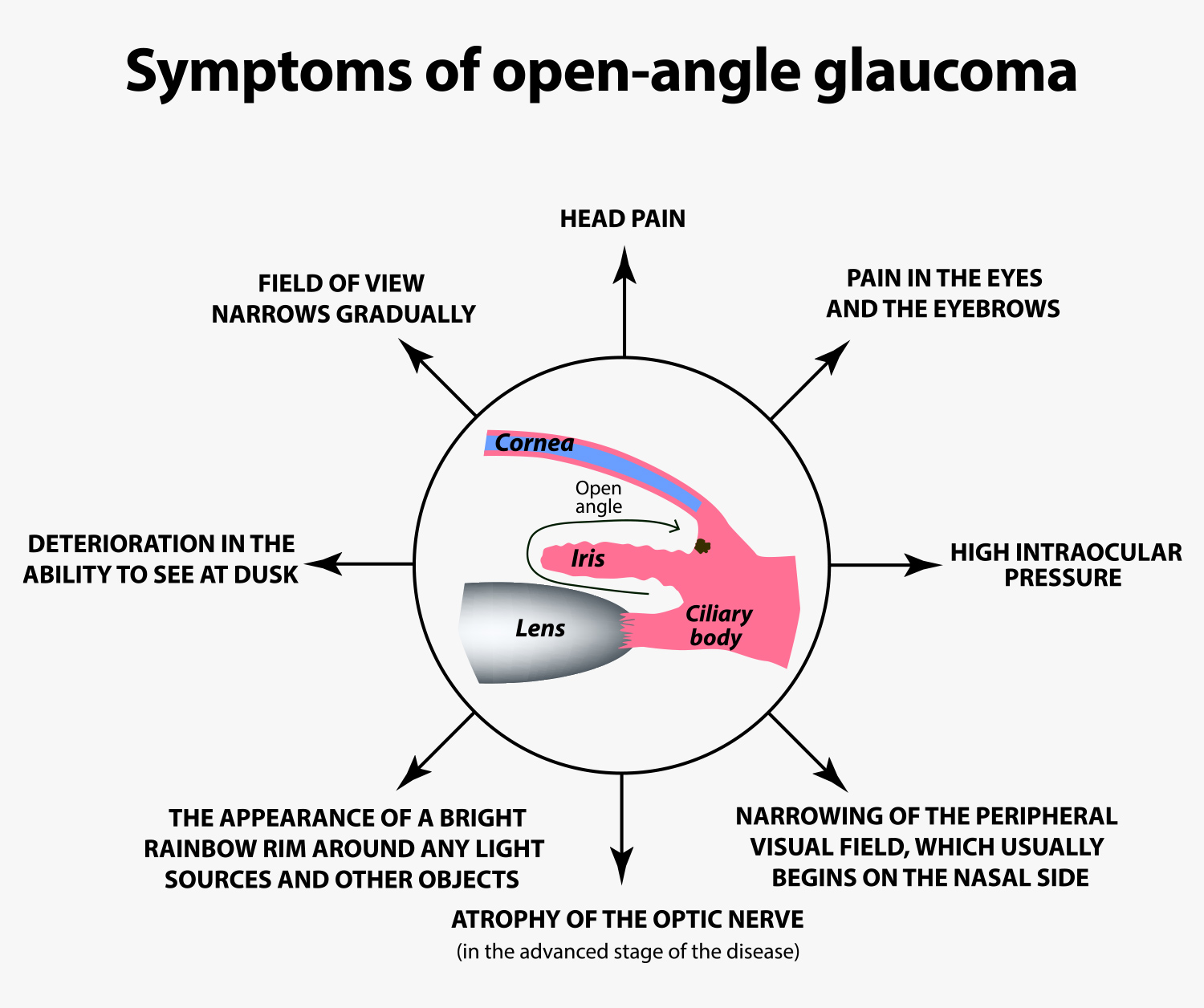 Open Angle Glaucoma Symptoms