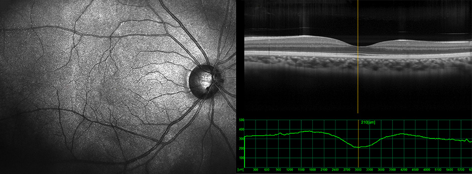 AMD Ophthalmic Test