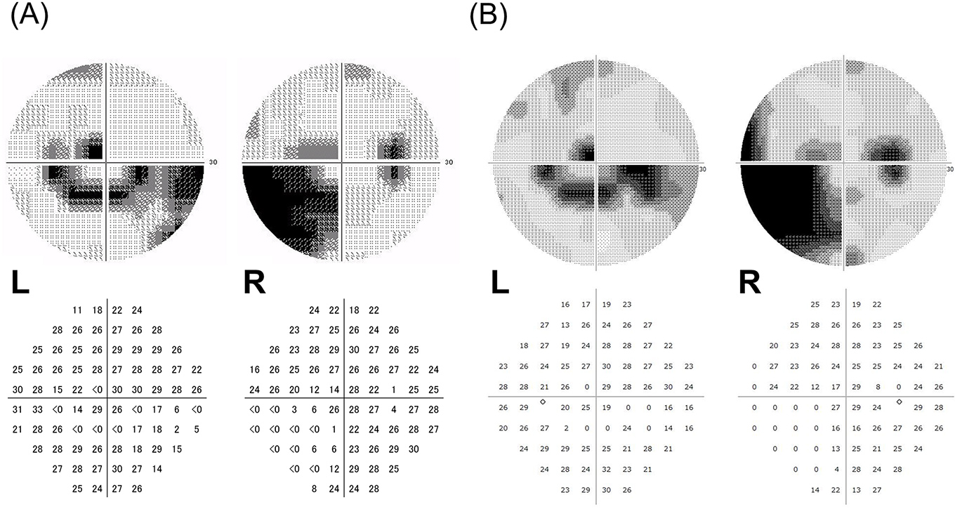 Visual Field Test