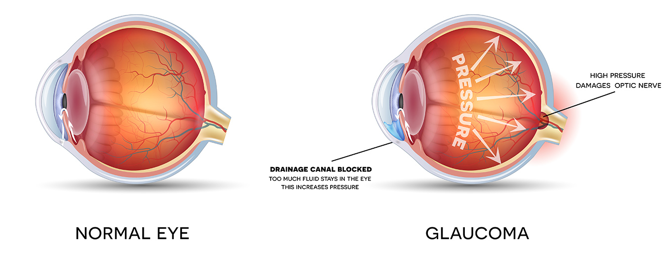 Glaucoma Diagram