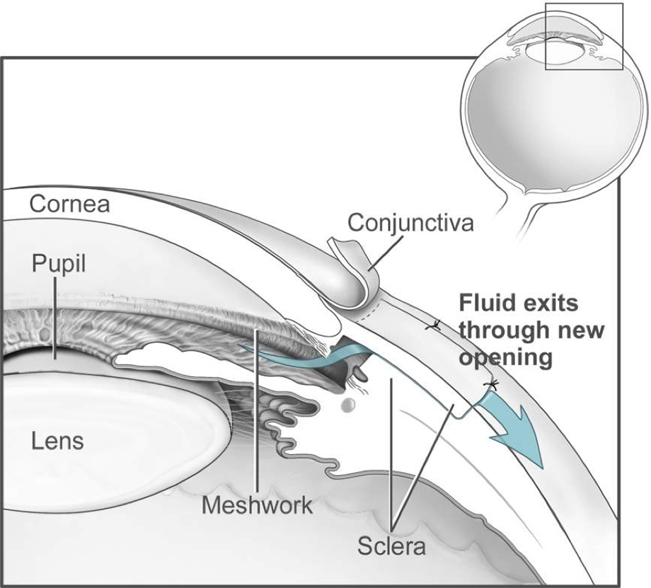 Trabeculectomy