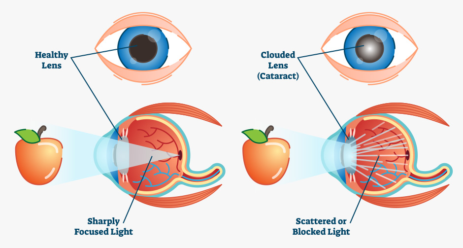 Cataract Diagram