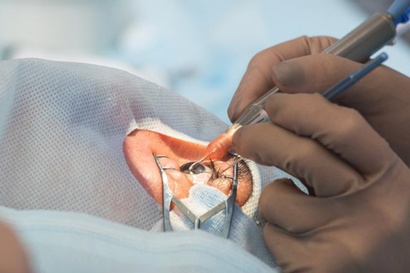 Cataract Operation